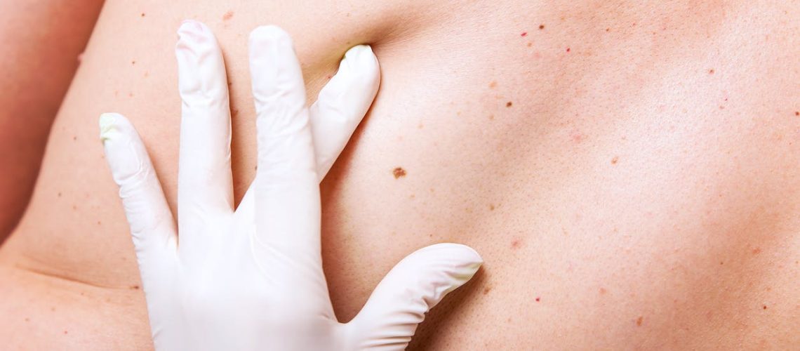 Comment se débarrasser des boutons d'acné dans le dos ?